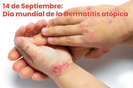 Día Mundial de la Dermatitis Atópica