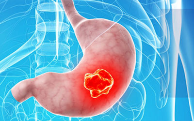 Día Mundial del Cáncer Gástrico