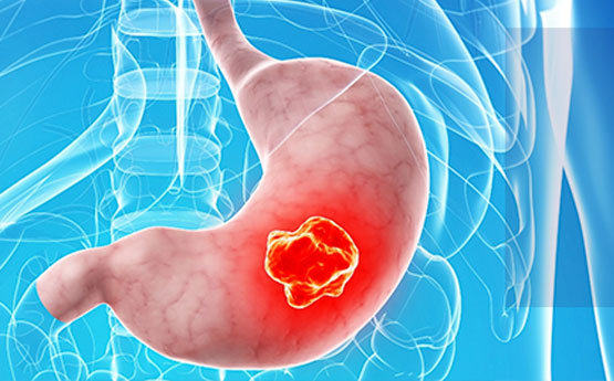 Día Mundial del Cáncer Gástrico